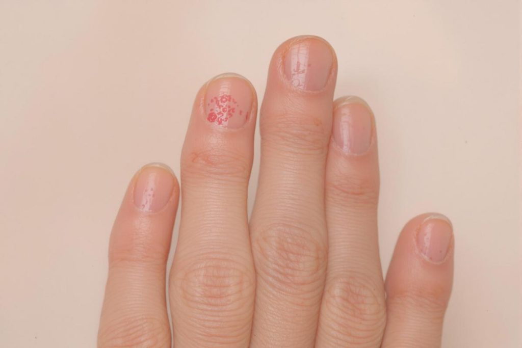 Quelle maladie fait gonfler les doigts de la main ?.jpg